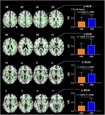 Brain Structural and Functional Alterations Specific to Low Sleep Efficiency in Major Depressive Disorder